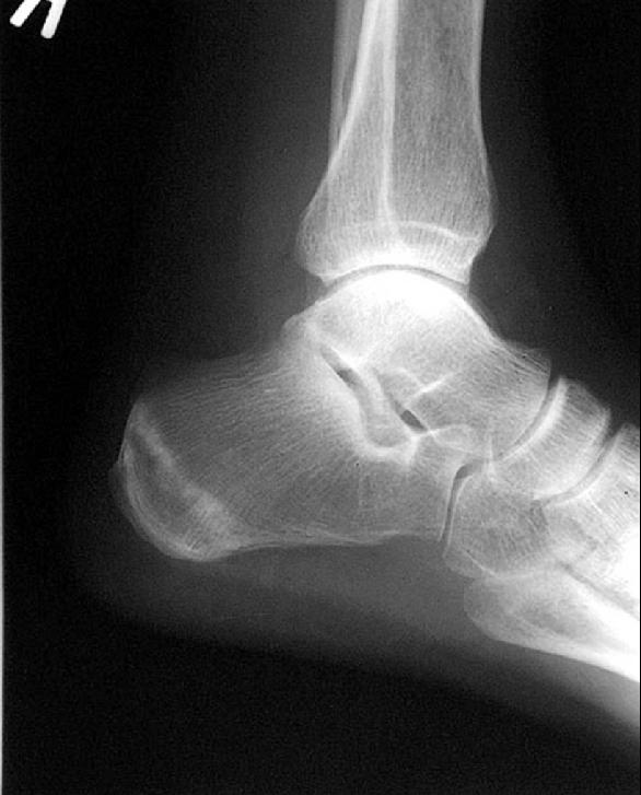 Xray: Calcaneal stress fracture