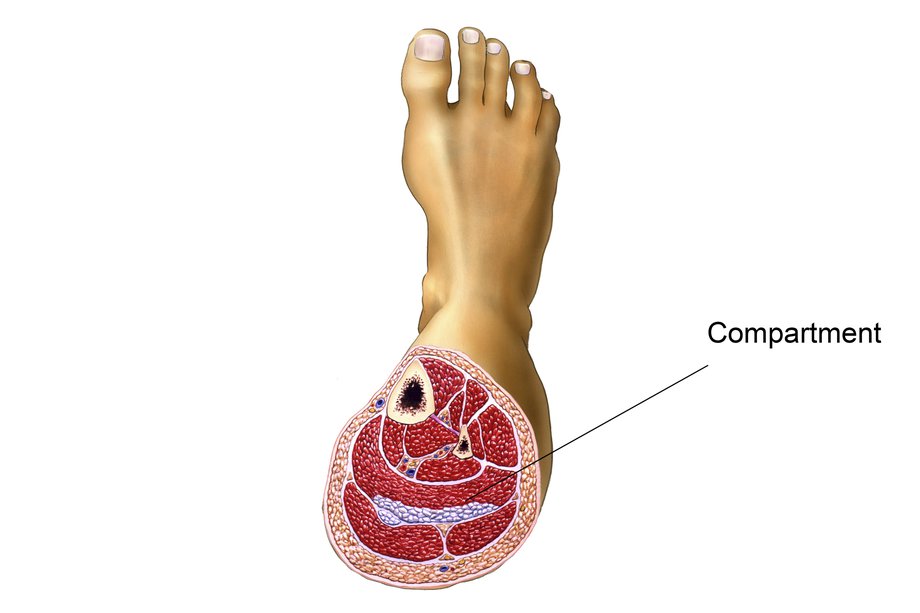 File:Compartment syndrome.jpg