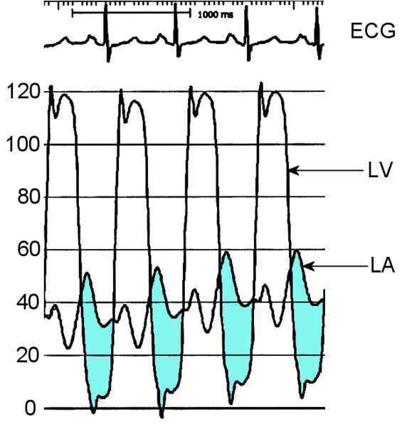 Intracardiac pressure measurements in an individual with severe mitral stenosis. Pressure tracings in the left atrium (LA) and the left ventricle (LV) in an individual with severe mitral stenosis. Blue areas represent the diastolic pressure gradient due to the stenotic valve.