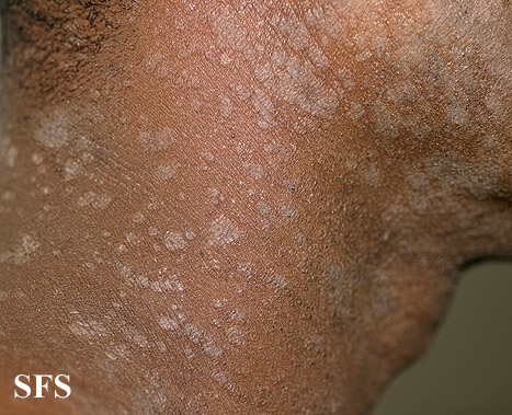 Pityriasis rosea. Adapted from Dermatology Atlas.[1]