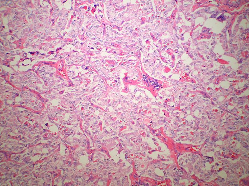 Low magnification micrograph of medullary thyroid carcinoma<ref> Medullary thyroid cancer librepathology