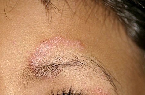 Tinea facei. Adapted from Dermatology Atlas.[3]