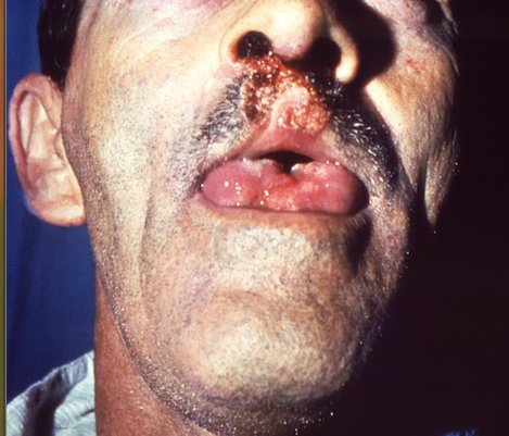 Fungal infection of the face affecting his right eye, upper lip, nares, and tongue. Brazilian blastomycosis, is caused by the fungal organism, Paracoccidioides brasiliensis. From Public Health Image Library (PHIL). [32]