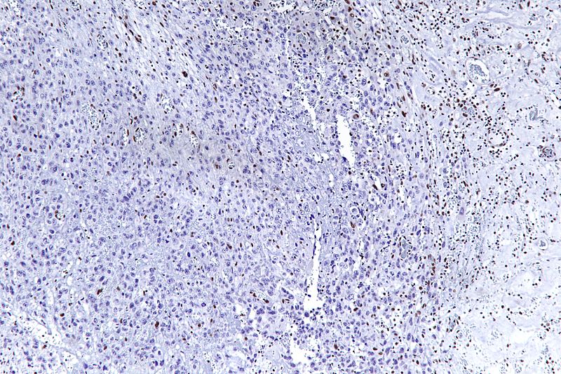 File:Epithelioid sarcoma - smarcb1 - intermed mag.jpg