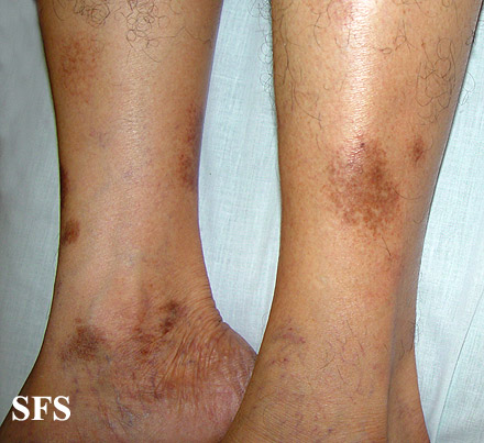 Majocchi’s disease. Adapted from Atlas<ref name="www.atlasdermatologico.com.br">"Dermatology Atlas".