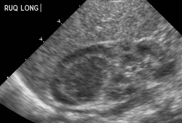 Ultrasonography: Adrenal hemorrhage