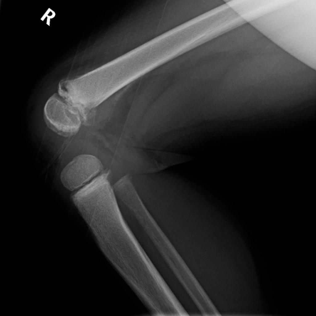 Lateral knee X ray[1]