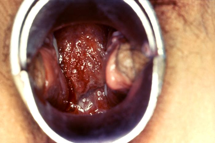 Woman’s cervix has manifested signs of a erosion and erythema due to chlamydial infection. From Public Health Image Library (PHIL). [3]