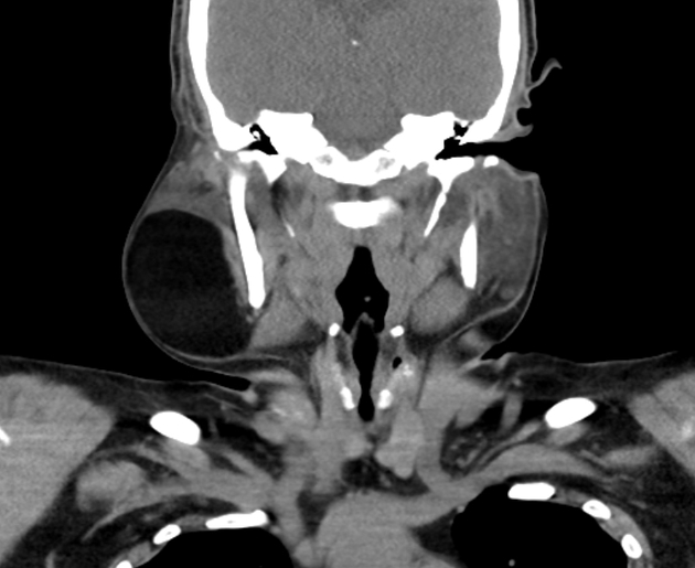 Coronal non contrast CT of parotid lipoma[3]