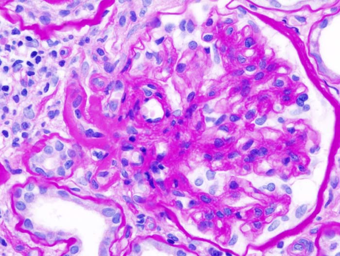 Histopathological image of diabetic glomerulosclerosis with nephrotic syndrome. PAS stain.