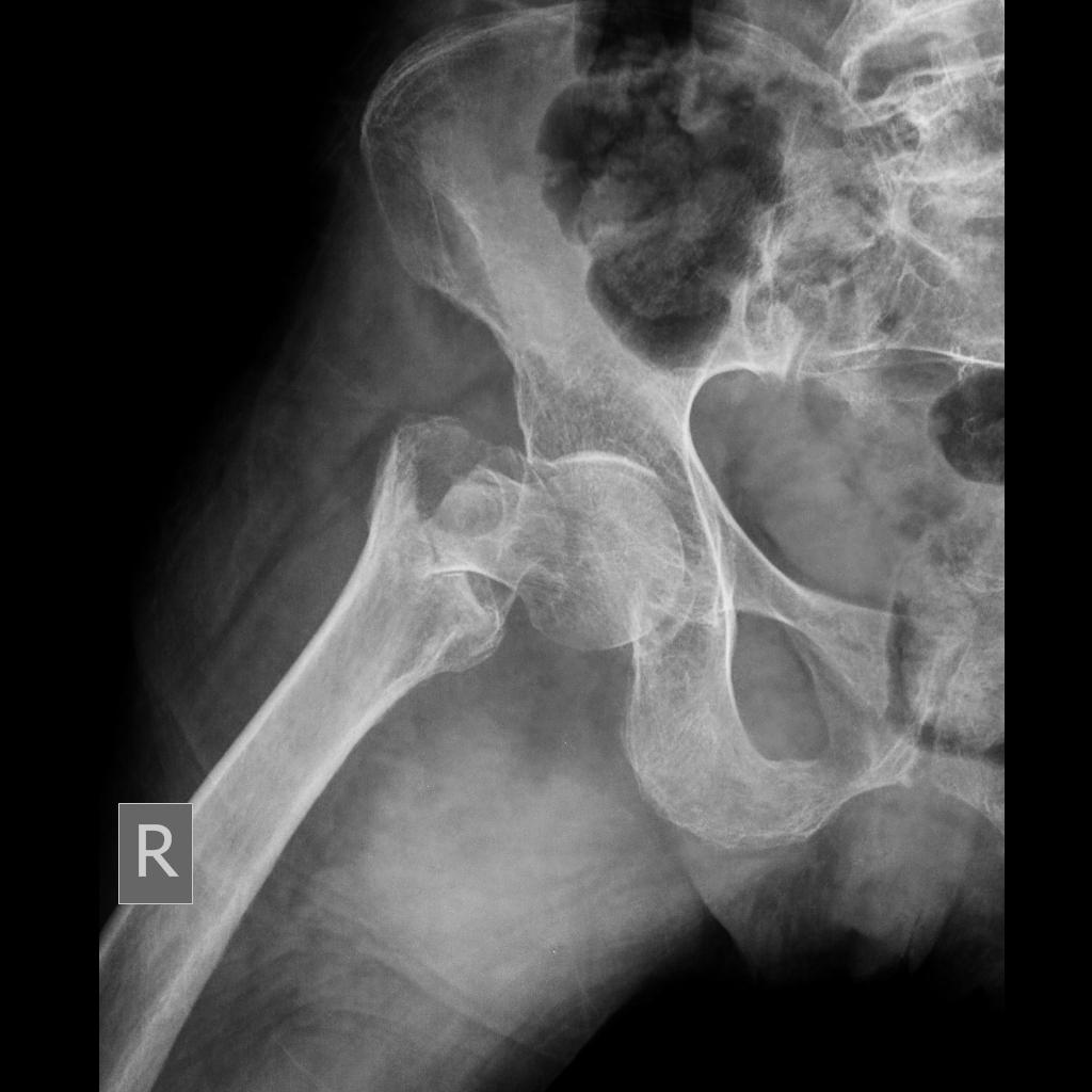 Fracture at the base of the right femoral neck.