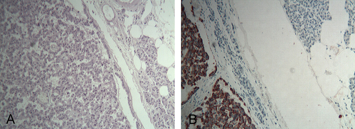 Histopathological examination of the pancreatic tumor.A) The tumor appears encapsulated and composed of polygonal cells with trabecular or ribbon-like proliferation (HE 5 X). B) At immunohistochemistry, neoplastic cells showed an intense diffuse staining for glucagon (Anti-glucagon antibody 5 X)[12]