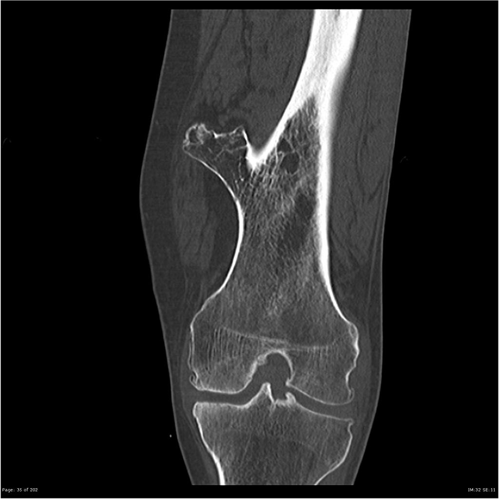 CT (coronal view): femur osteochondroma