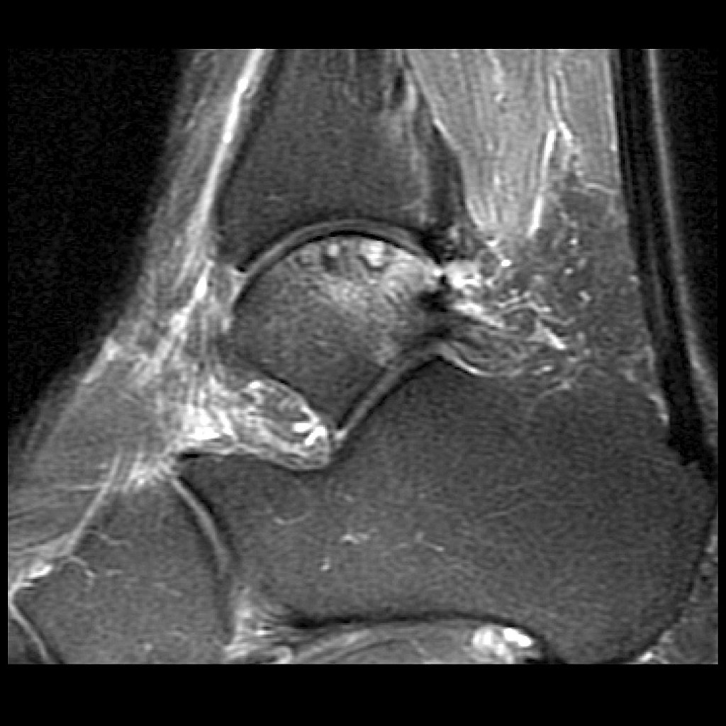 PD Subchondral fracture of the talar dome. Note the intact overlying cartilage.