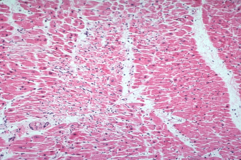 Lupus Erythematosus Myocardial Necrosis Due To Libman Sacks: Micro low mag H&E well shown focal myocardial necrosis due to embolism from mitral Libman Sacks lesion