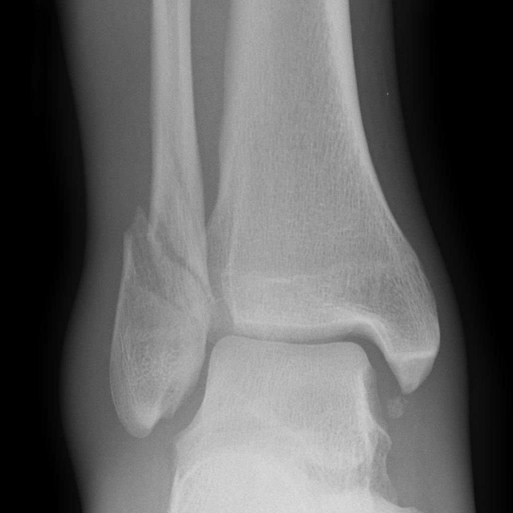 Ankle-fracture-weber-B