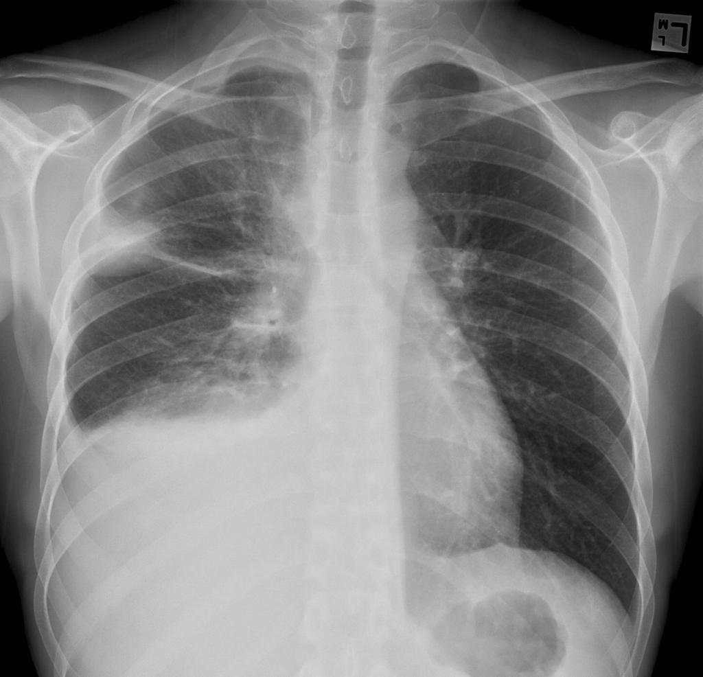 Large unilateral right side pleural effusion can be seen with no fluid on the left. There is no evidence of cardiomegaly. There is an lesion with increased opacity on the peripheral of right upper lung field and another lesion located at the right hilum.[2]