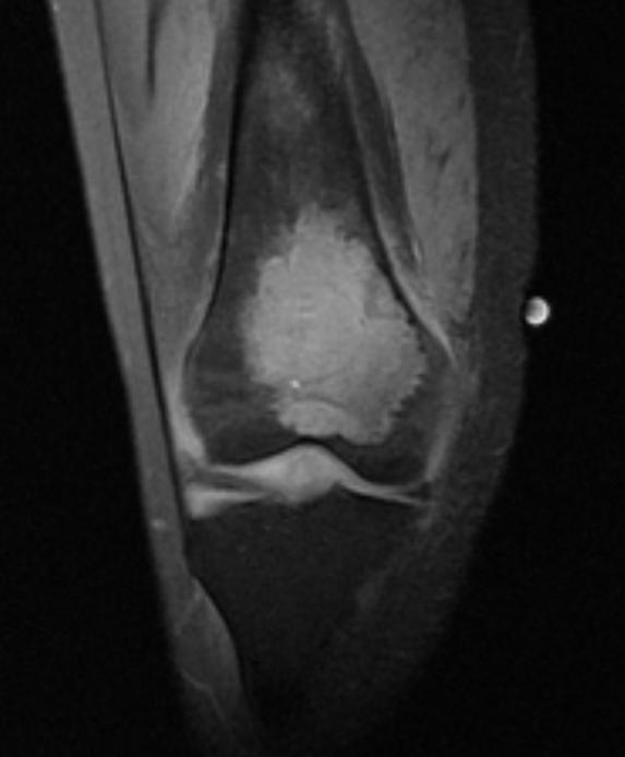 Giant cell tumor: Distal part of the femur