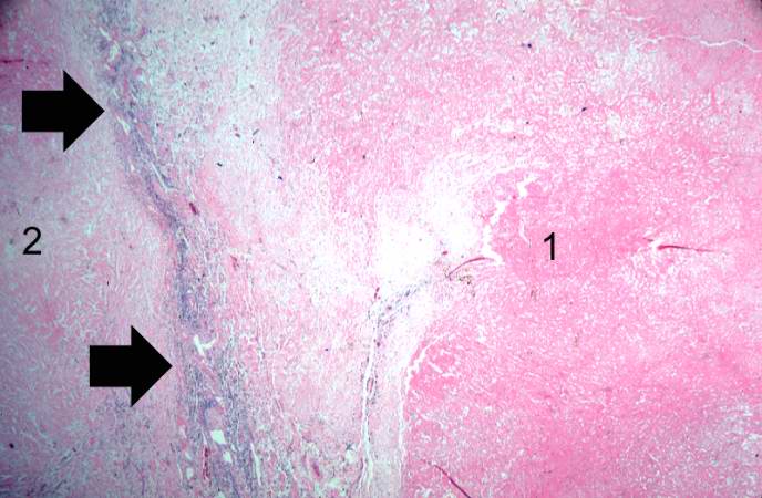 This higher-power photomicrograph shows the border between the thrombus on the right (1) and the endocardium on the left (2). There is a line of inflammatory cells at this interface (arrow).