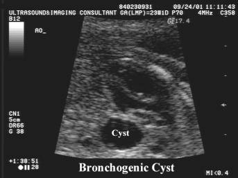 File:Ultrasound of bronchogenic cyst...jpg