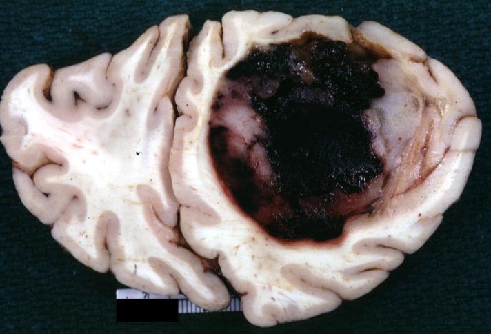 Gross specimen of oligodendroglioma demonstrate large, well circumscribed lesion in left frontal lobe.