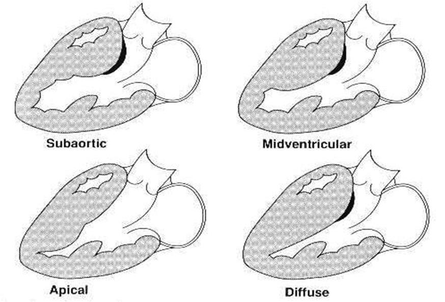Variants of hypertrophic cardiomyopathy