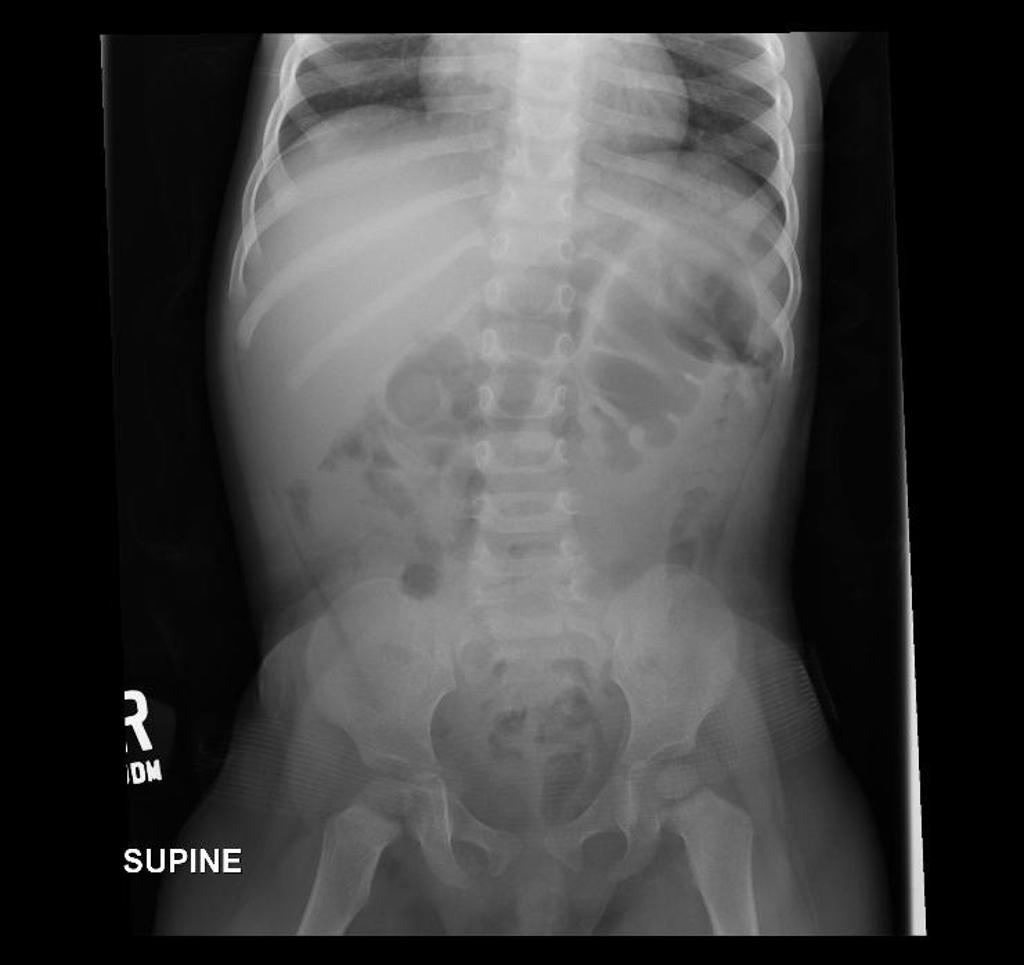 File:Intussusception 1.jpg