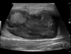 File:Breast abscess - Ultrasound.gif
