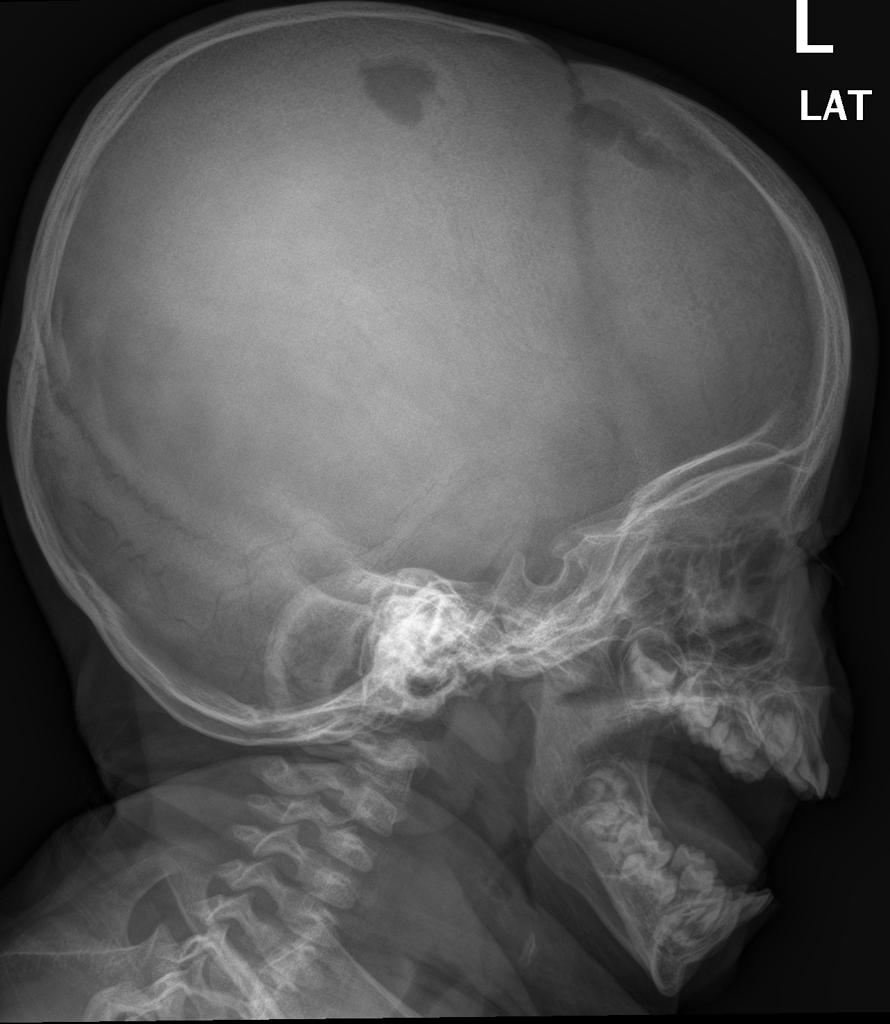 Langerhans cell histiocytosis punched-out lytic skull lesions