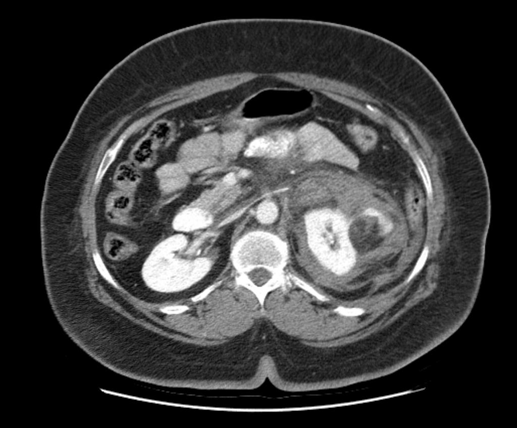 File:Retroperitoneal-haemorrhage-from-renal-angiomyolipoma.jpg