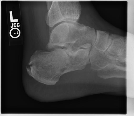 Calcaneal fracture with decreased Bohler's angle.