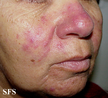 Acne rosacea. Adapted from [http://www.atlasdermatologico.com.br/disease.jsf?diseaseId=6