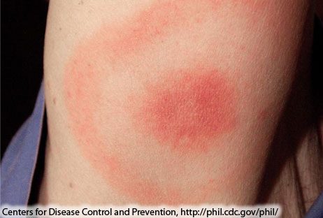 File:Classic Lyme disease rash.jpg