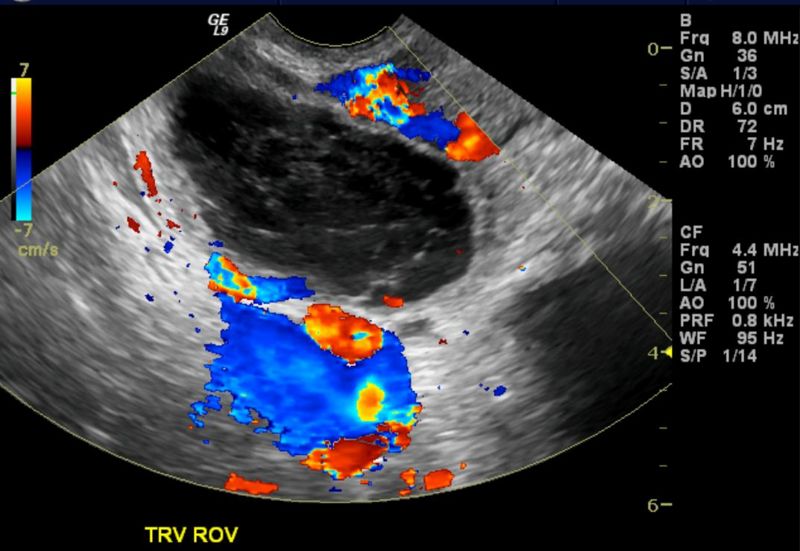 Hemorrhagic ovarian cyst 003.jpg