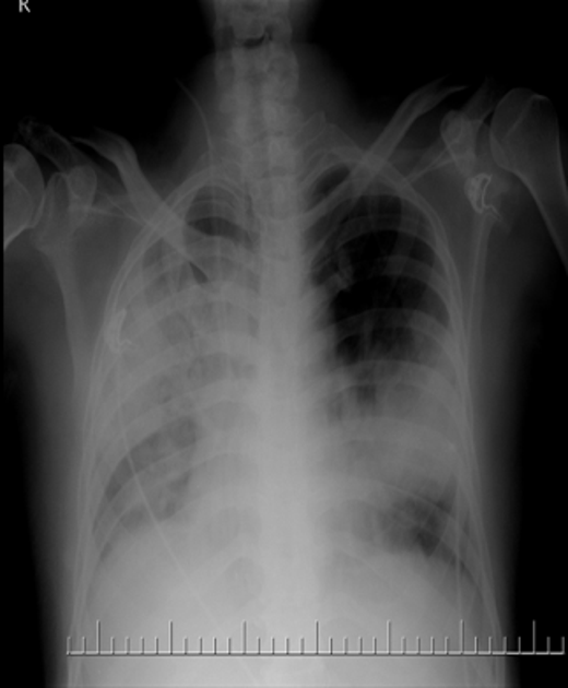 File:Hospital acquired pneumonia.png