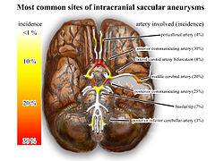 File:Intracranial aneurysms - inferior view - heat map.jpg