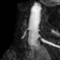 MRA: Renal artery stenosis.