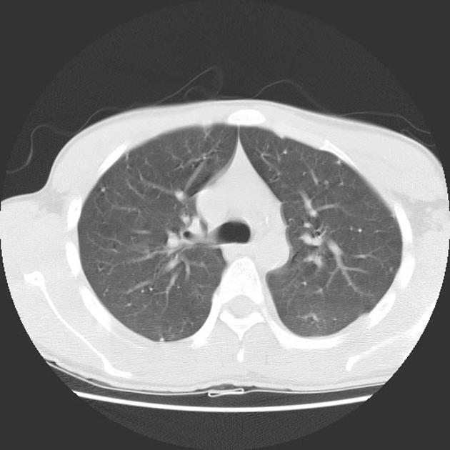 File:Varicella Pneumonia CT - 1.jpg