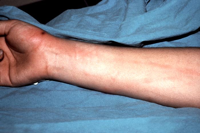 This patient presented with a lesion of the right hand due to a disseminated Neisseria gonorrhoeae bacteremia. Though a sexually transmitted disease, if a Gonorrhea infection is allowed to go untreated, the Neisseria gonorrhea bacteria responsible for the infection can become disseminated throughout the body, forming lesions in extra-genital locations.Adapted from CDC