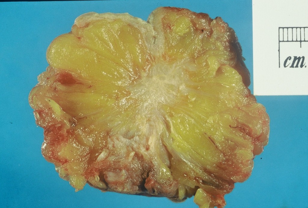 Excised human breast tissue, showing a stellate area of cancer 2cm in diameter. The lesion could be felt clinically as a hard mobile lump, not attached to skin or chest wall.