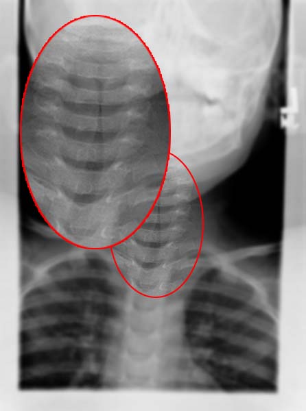 Frontal view of the steeple sign in a croup patient. From Radiopaedia Image Library. [2]