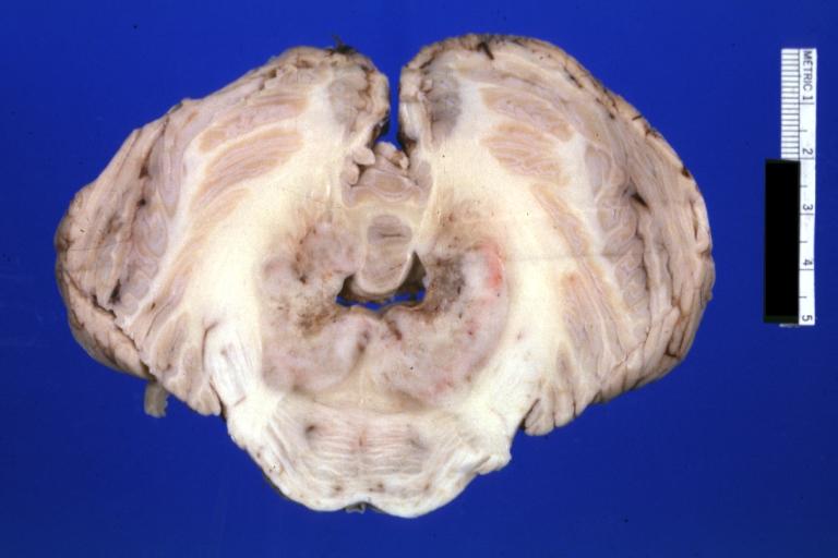 Brain: Microglioma: Gross fixed tissue horizontal section rostral pons and cerebellum