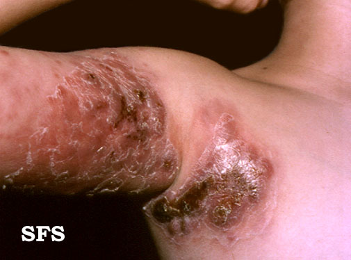 Hodgkin’s disease. With permission from Dermatology Atlas.[2]