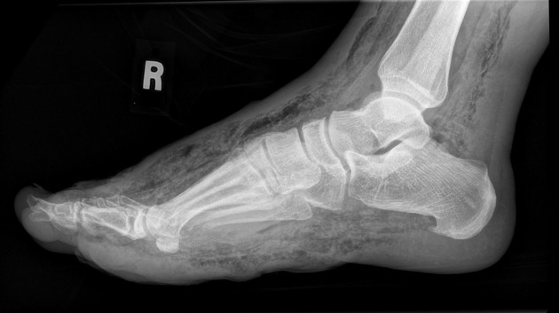 X ray (Necrotizing fasciitis of diabetic foot) - Case courtesy of Dr Wael Nemattalla, Radiopaedia.org, rID: 8674