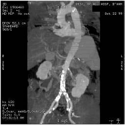 File:Renal artery stenosis 042.jpg