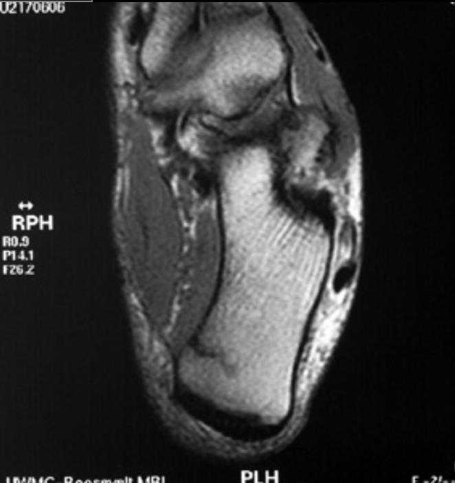 MRI reveals a calcaneal stress fracture