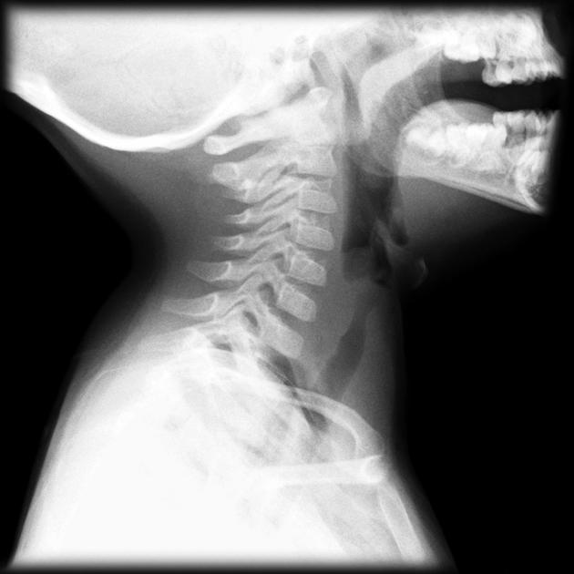 Lateral view of the steeple sign in a croup patient. From Radiopaedia Image Library. [2]
