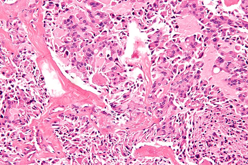 High magnification micrograph of medullary thyroid carcinoma<ref> Medullary thyroid cancer librepathology