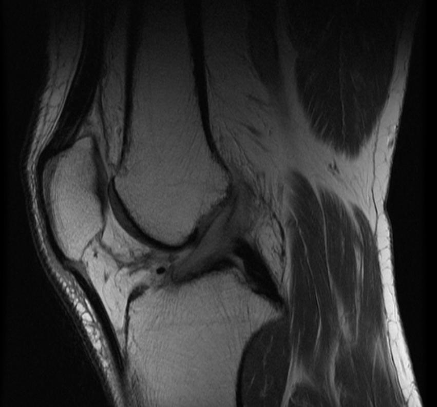 File:Mucoid degeneration of the anterio cruciate ligament MRI 001.jpg