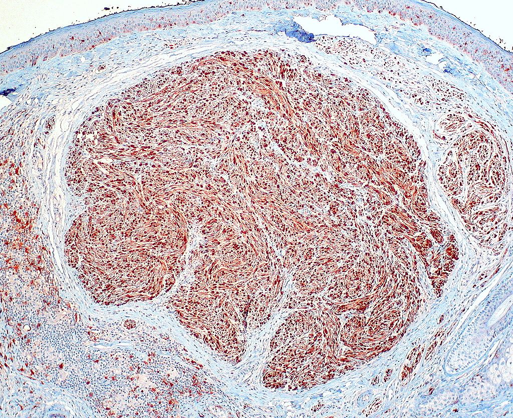 File:Palisaded and Encapsulated Neuroma, S-100 Immunostain (3953412396).jpg